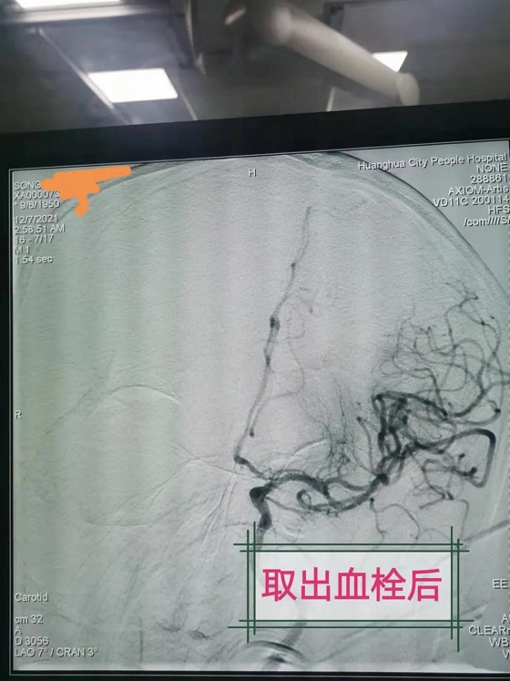 【医心为民解危难 团队妙手除偏瘫】黄骅市人民医院神经内科及时救治一脑内大动脉血栓病人