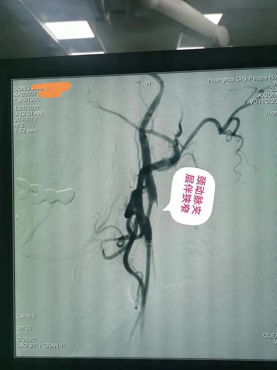 【医心为民解危难 团队妙手除偏瘫】黄骅市人民医院神经内科及时救治一脑内大动脉血栓病人